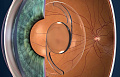 Лечение катаракты с заменой хрусталика